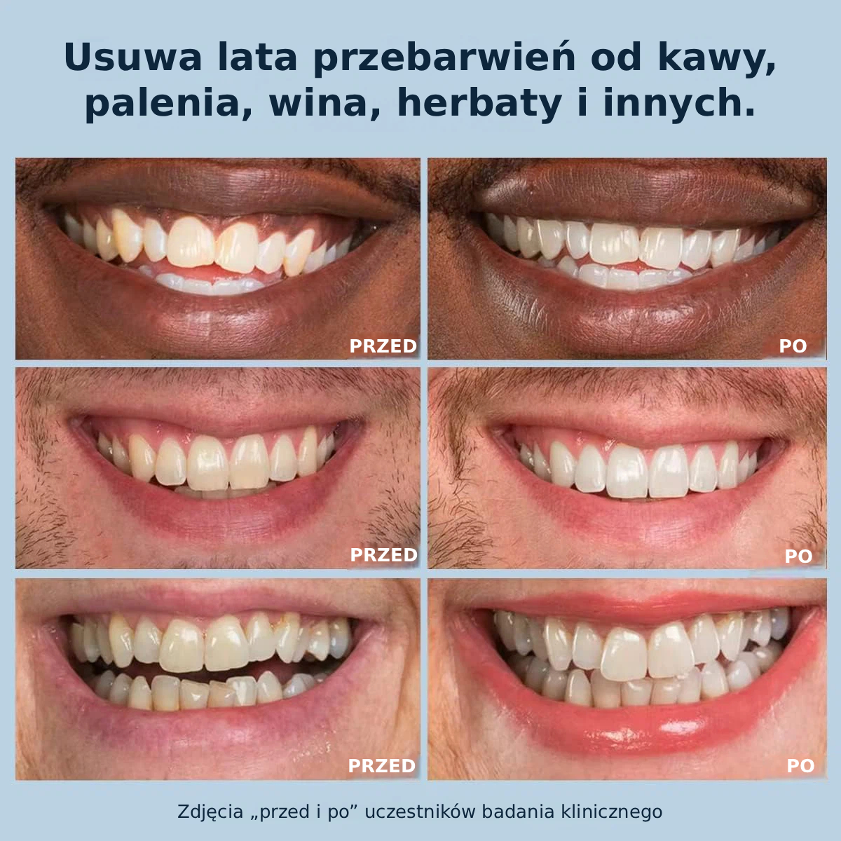 Żel wybielający
